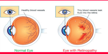मधुमेहपीडितमा 'डायबेटिक रेटिनोपेथी'को जोखिम